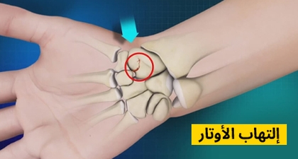 التهاب الأوتار