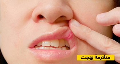 متلازمة بهجت