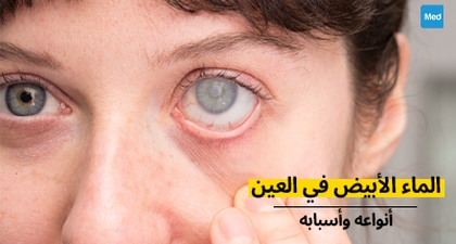 الماء الأبيض في العين : أنواعه وأسبابه