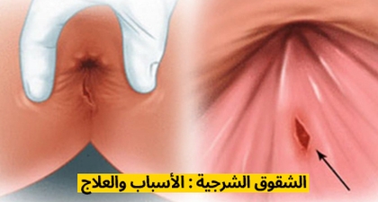 الشقوق الشرجية : الأسباب والعلاج