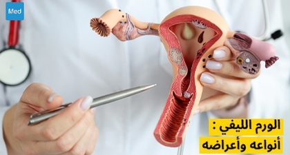 الورم الليفي : أنواعه وأعراضه