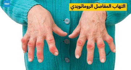 التهاب المفاصل الروماتويدي