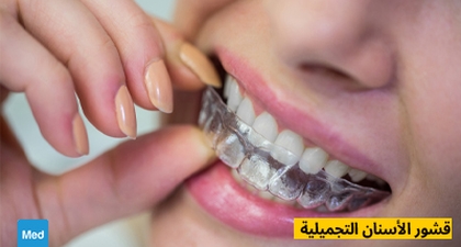 قشور الأسنان التجميلية