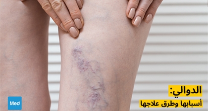 الدوالي: أسبابها وطرق علاجها