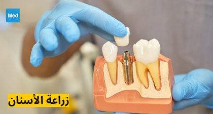 زراعة الأسنان