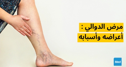 مرض الدوالي : أعراضه وأسبابه