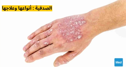 الصدفية : أنواعها وعلاجها