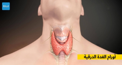 أورام الغدة الدرقية
