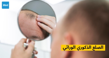 الصلع الذكوري الوراثي