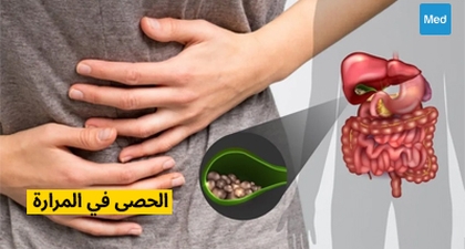 الحصى في المرارة