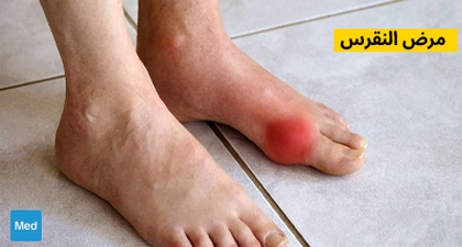 مرض النقرس - التشخيص والأسباب والعلاج