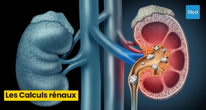 La Lithiase Urinaire : De la Chirurgie à la Prévention 