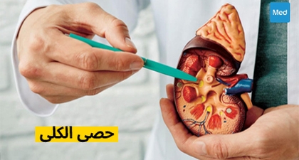 حصى الكلى: الأسباب والأعراض والعلاج
