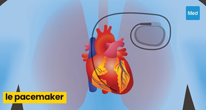 Qu'est-ce qu'un Pacemaker ?