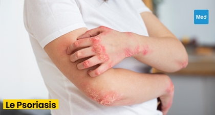 Psoriasis : comprendre la maladie et vivre au mieux