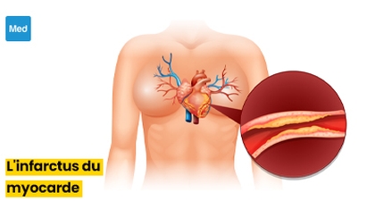  Tout ce que vous devez savoir sur l'infarctus du myocarde : Symptômes, facteurs de risque et prévention