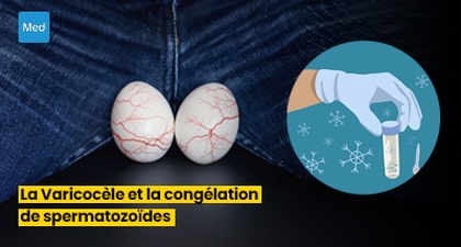 La Varicocèle et la Congélation de Spermatozoïdes : Préservation de la Fertilité avant une Intervention