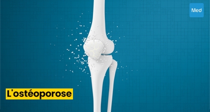 Comprendre et Prévenir l'Ostéoporose : Des Os Solides pour une Vie Saine