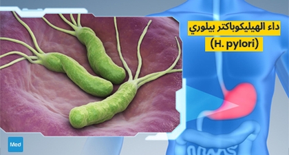 داء الهيليكوباكتر بيلوري (H. pylori)