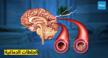 الجلطات الدماغية: الأسباب، الأعراض، التشخيص، والعلاج
