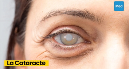 Comprendre la Cataracte : Symptômes, Causes, Traitement et Prévention