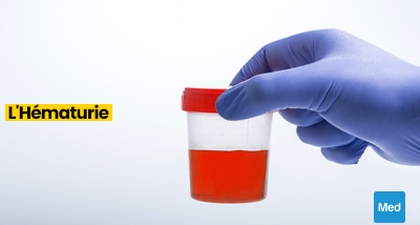 Comprendre l'Hématurie : Sang dans l'Urine, Causes et Préoccupations