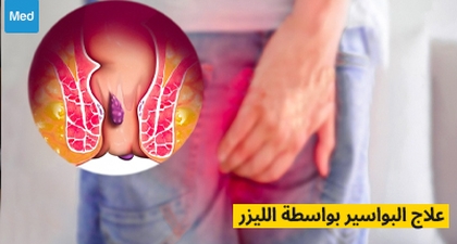 علاج البواسير بواسطة الليزر