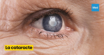 La cataracte : une maladie oculaire qui peut affecter la qualité de vie