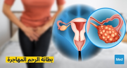 بطانة الرحم المهاجرة