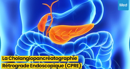Tout ce que vous devez savoir sur la Cholangiopancréatographie Rétrograde Endoscopique (CPRE)