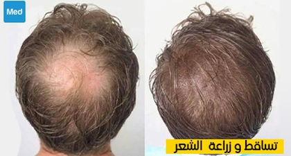 تساقط وزراعة الشعر