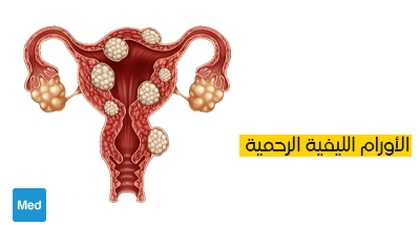 الأورام الليفية الرحمية: تعريف، أعراض، تشخيص وعلاج