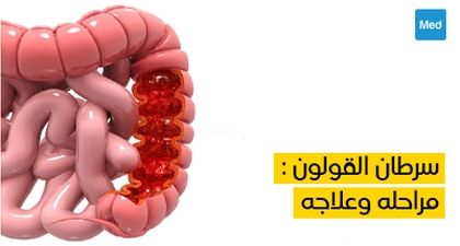 سرطان القولون : مراحله وعلاجه