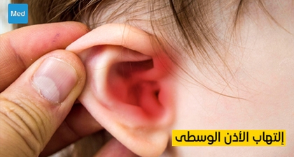 التهاب الأذن الوسطى