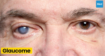 Le glaucome : une maladie grave mais traitable