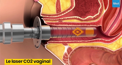 Le laser CO2 vaginal : une solution non invasive pour améliorer la santé et le bien-être intimes