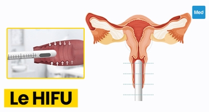 HIFU gynécologique : une nouvelle technique prometteuse