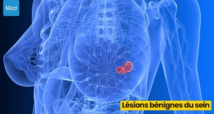 Lésions bénignes du sein