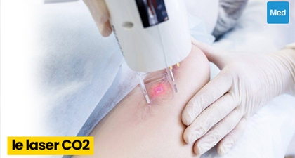 Laser CO2 pour les taches pigmentaires et les cicatrices d’acné