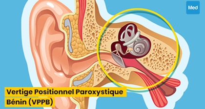Vertige Positionnel Paroxystique Benin (VPPB) 