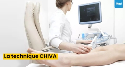 La technique CHIVA : une alternative à la chirurgie des varices