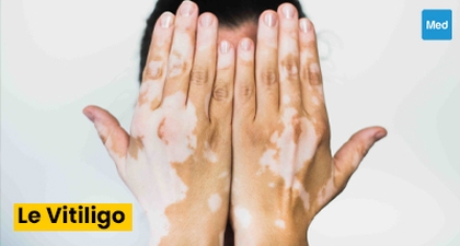 Vitiligo : tout ce que vous devez savoir