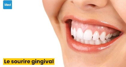 Le sourire gingival : définition, causes, diagnostic, traitement et prévention