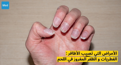 الأمراض التي تصيب الأظافر : الفطريات و الظفر المغروز في اللحم