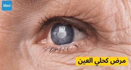 مرض كحلي العين