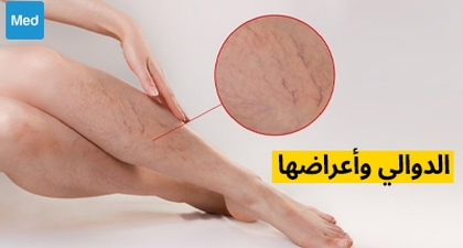 الدوالي وأعراضها