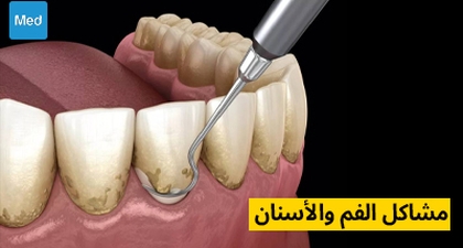 مشاكل الفم والأسنان 