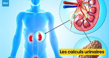 Les calculs urinaires : causes, symptômes et traitements