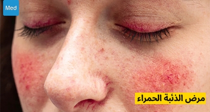 الذئبة الحمراء : فهم هذا المرض المناعي الذاتي