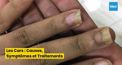 Maîtriser les Onychomycoses : Diagnostic, Traitement et Prévention